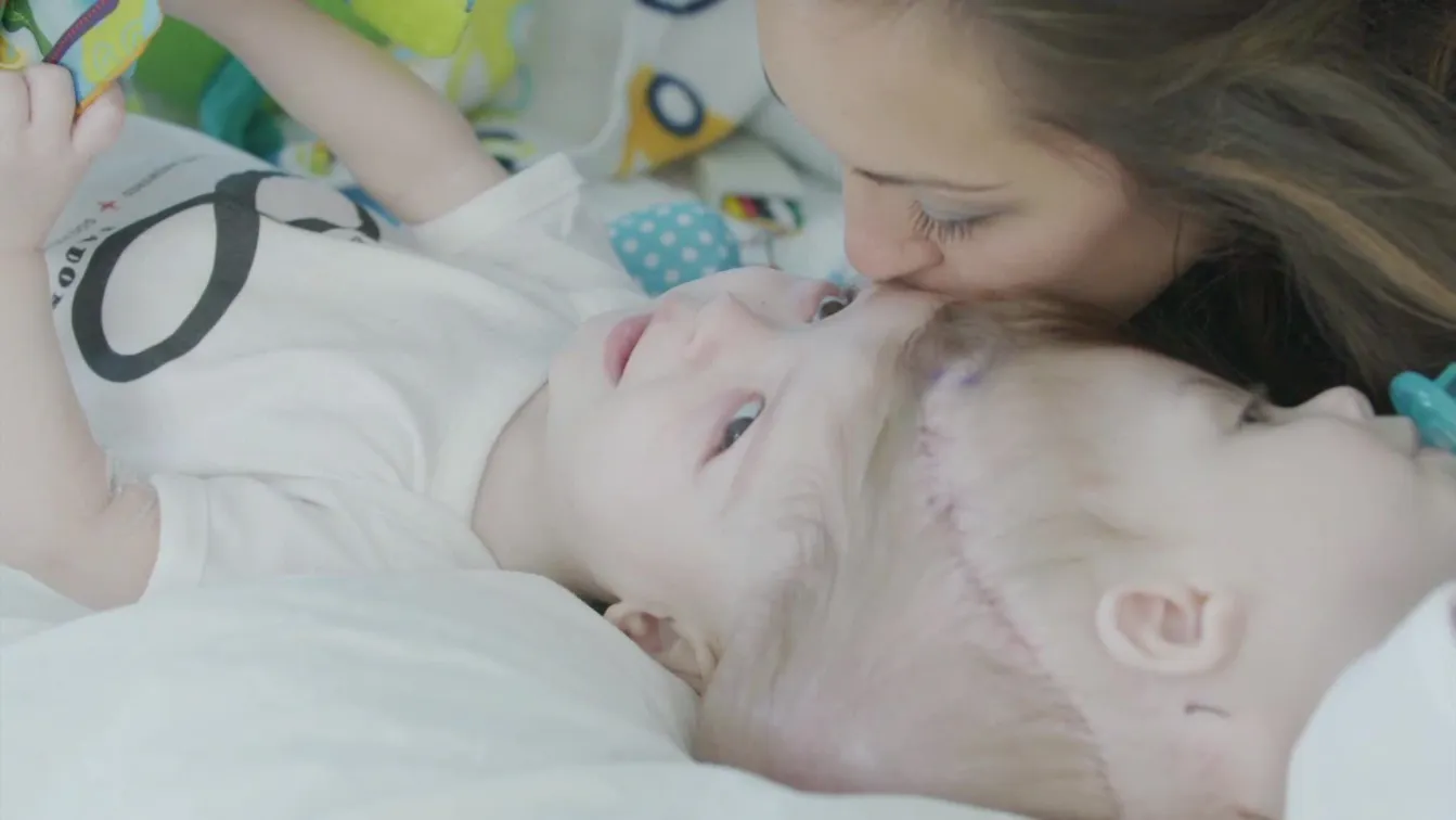 New life, apart: Brothers conjoined at head are in surgery | CNN | 101394