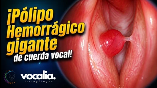 Pólipo Hemorrágico de Cuerdas Vocales - Hemorrhagic vocal fold polyp - Cuerdas Vocales - Vocalia | 108353