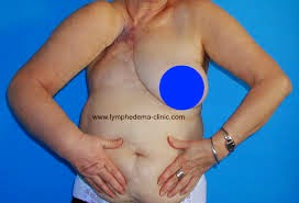Have Cancer - Have Lymphedema? What Is It? | 22390