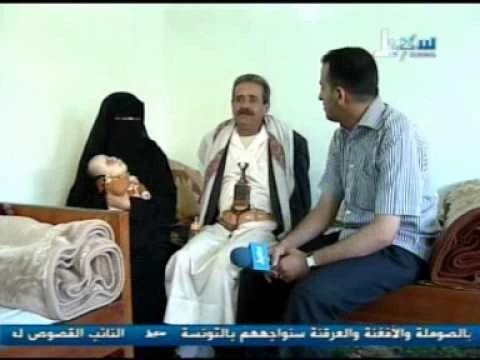 أغرب حالة تشوه في العالم في وجه طفل يمني | 83856