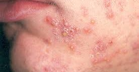 Herbal treatment of acne | 90820