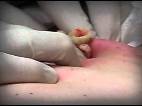 BIGGEST CYST ON THE PLANET | Operation Kill George | youtube.com | 91176