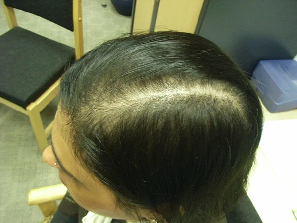 Remedies for Hair Loss - Regrow your Hair Tips | 92765