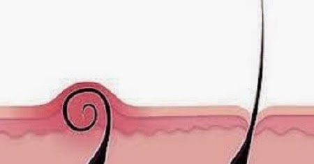 hair care: Hair growth under the skin, causes of the problem, treatment | 94237