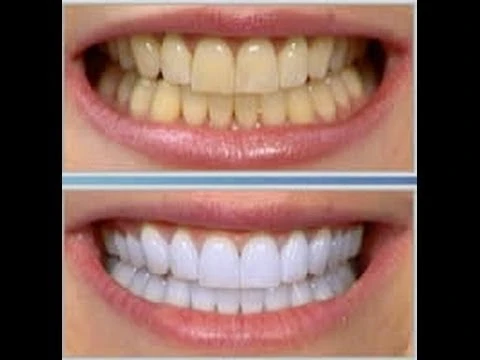تبيض الاسنان بالخلطات الطبيعية | 96042