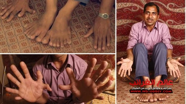 رجل هندي لديه 28 أصبعا | 97085